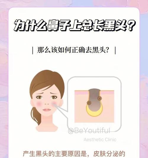 去黑头产品推荐——告别顽固黑头的利器（全面解析去黑头产品，让肌肤恢复清透无瑕）