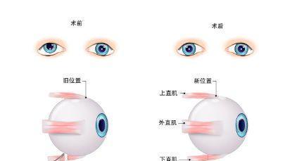 探究以后天斜视的成因及预防措施（解析以后天斜视的形成原因和有效防范方法）