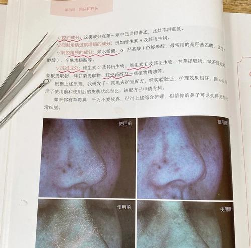 有效祛除黑头的方法（告别黑头）